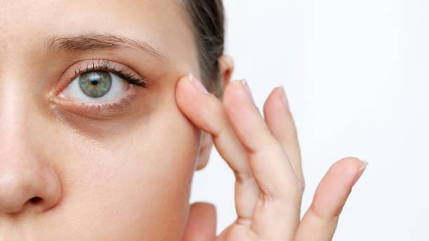Dile adiós a las ojeras y rejuvenece la mirada gracias a estos remedios caseros
